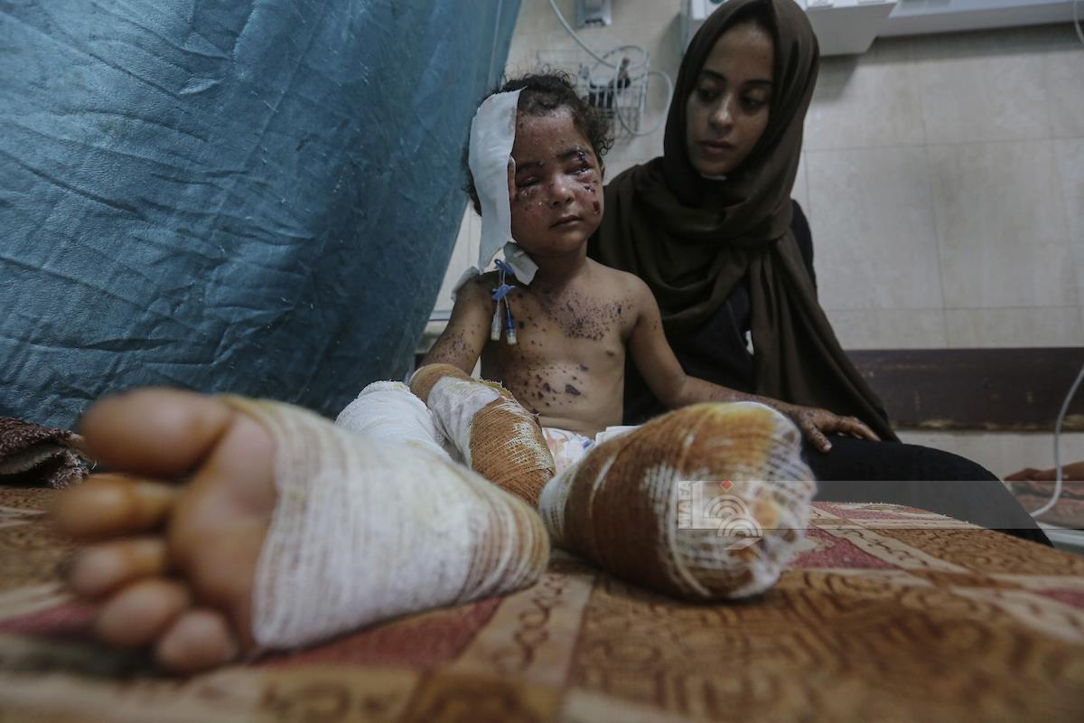 الطفلة أسيل رجب جمعة تتلقى العلاج في مستشفى شهداء الأقصى في دير البلح بعد إصابتها جراء قصف الاحتلال منزل عائلتها في مخيم البريج وسط قطاع غزة (وفا)